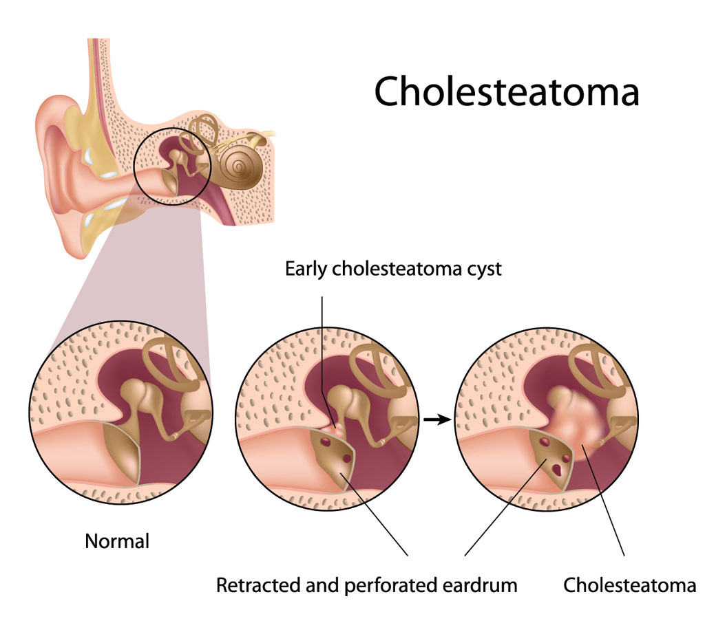 Endoscopic Middle Ear And Mastoid Surgery For Cholesteatoma At Harrison Endoscopic Middle Ear And Mastoid Surgery For Cholesteatoma At Harrison