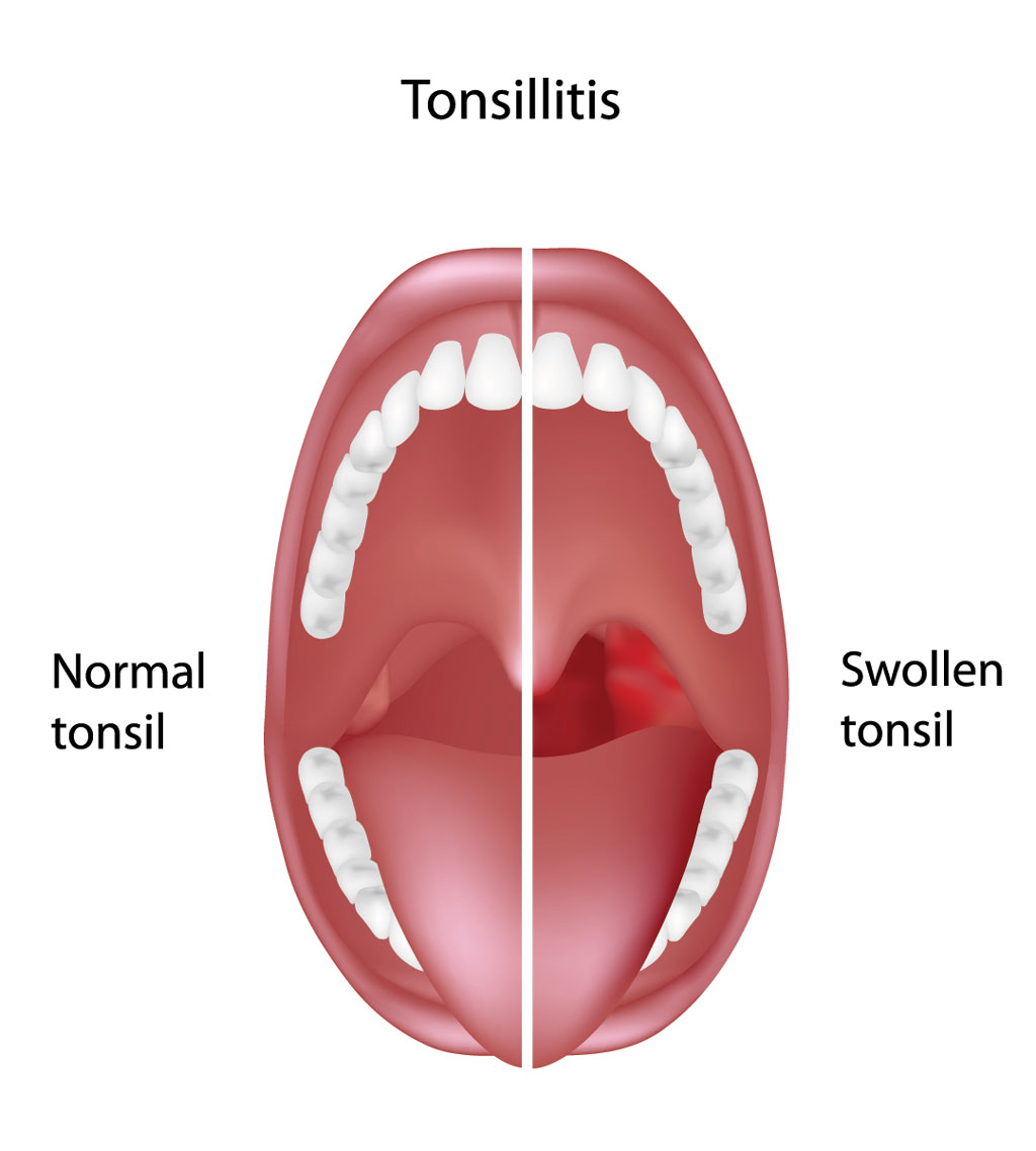 and throat Adult adenoids sore