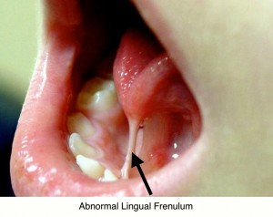 frenuloplasty in dibrugarh