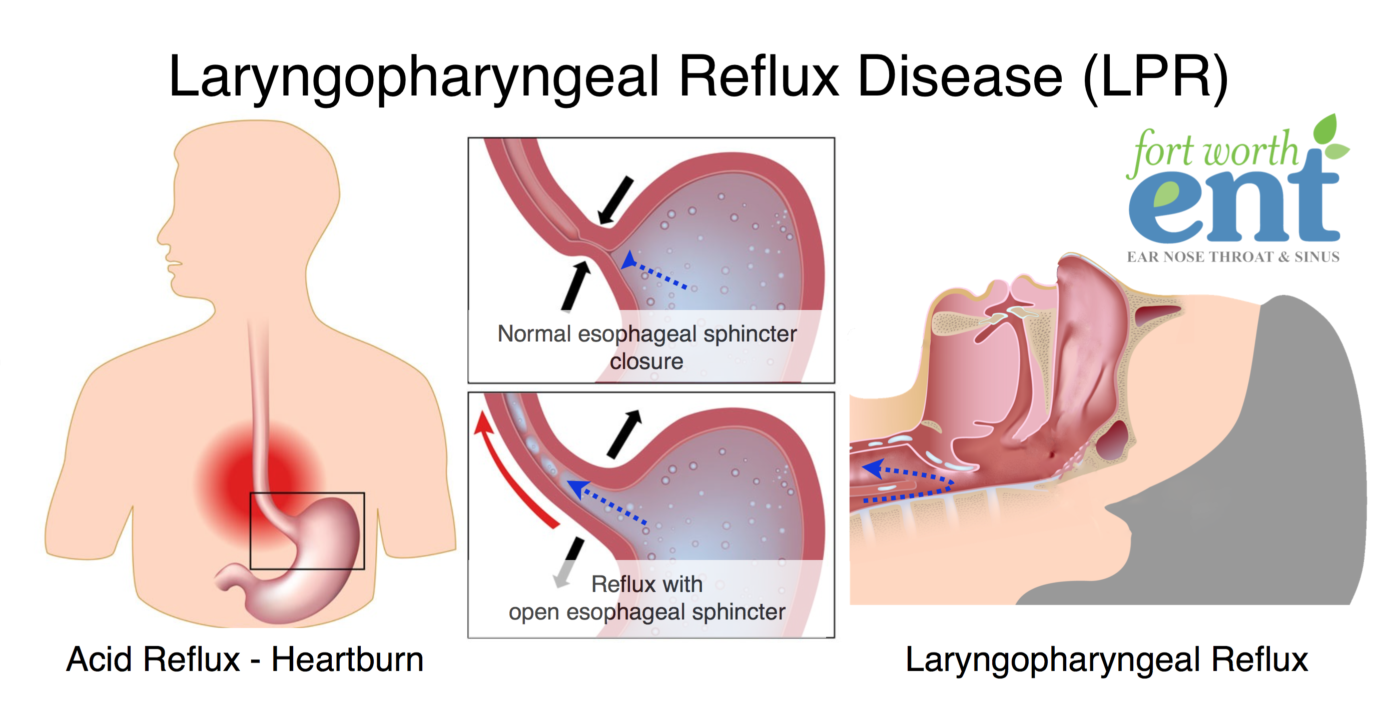 Laryngopharyngeal Reflux Disease LPR 