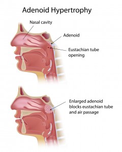 adenoidectomy