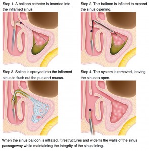 specialists for balloon simuplasty