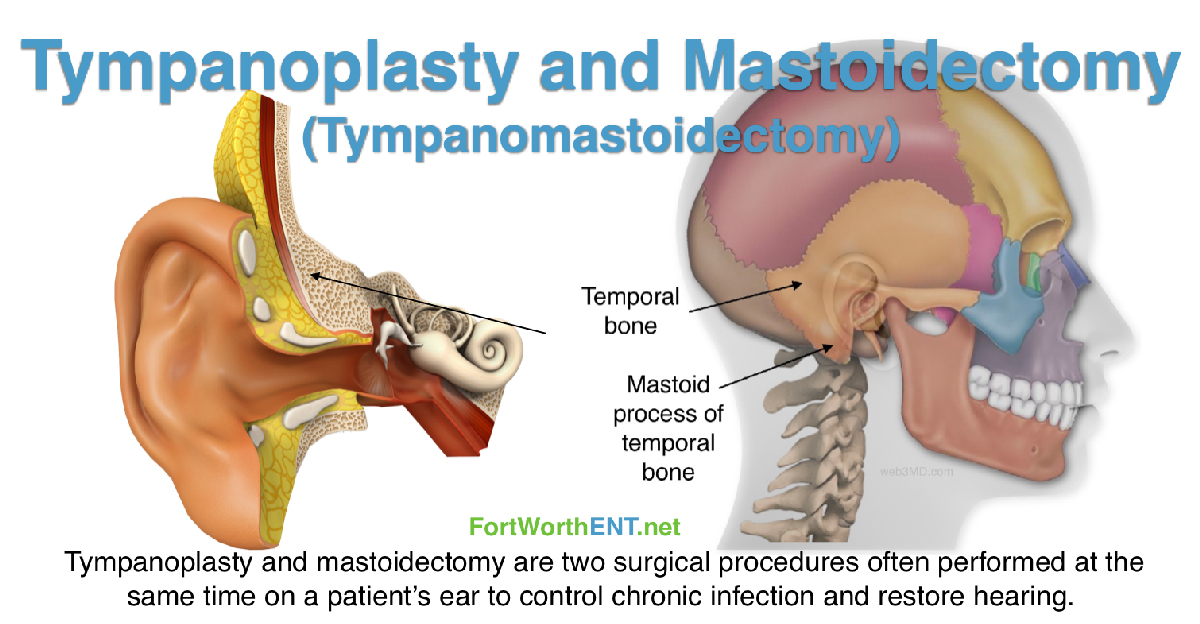 Tympanoplasty and Mastoidectomy (Tympanomastoidectomy)