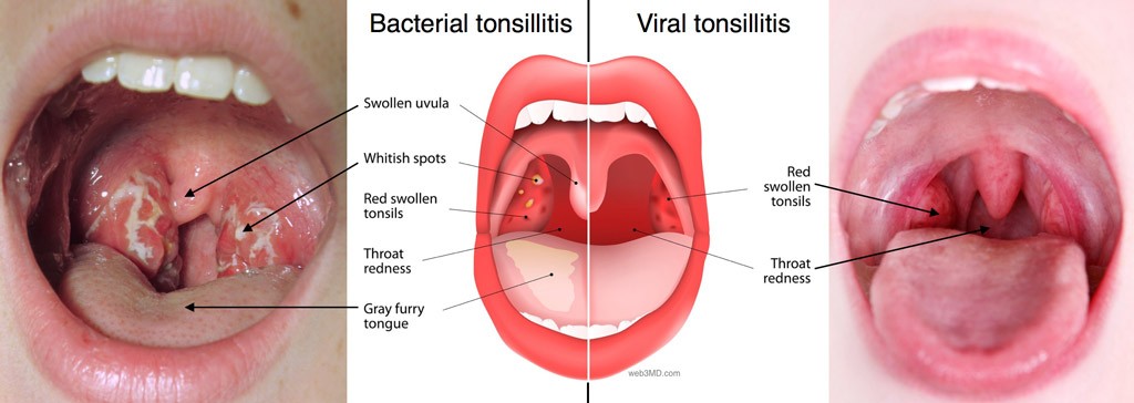 tonsillectomy and adenoidectomy post op