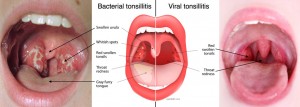 tonsillitis causes