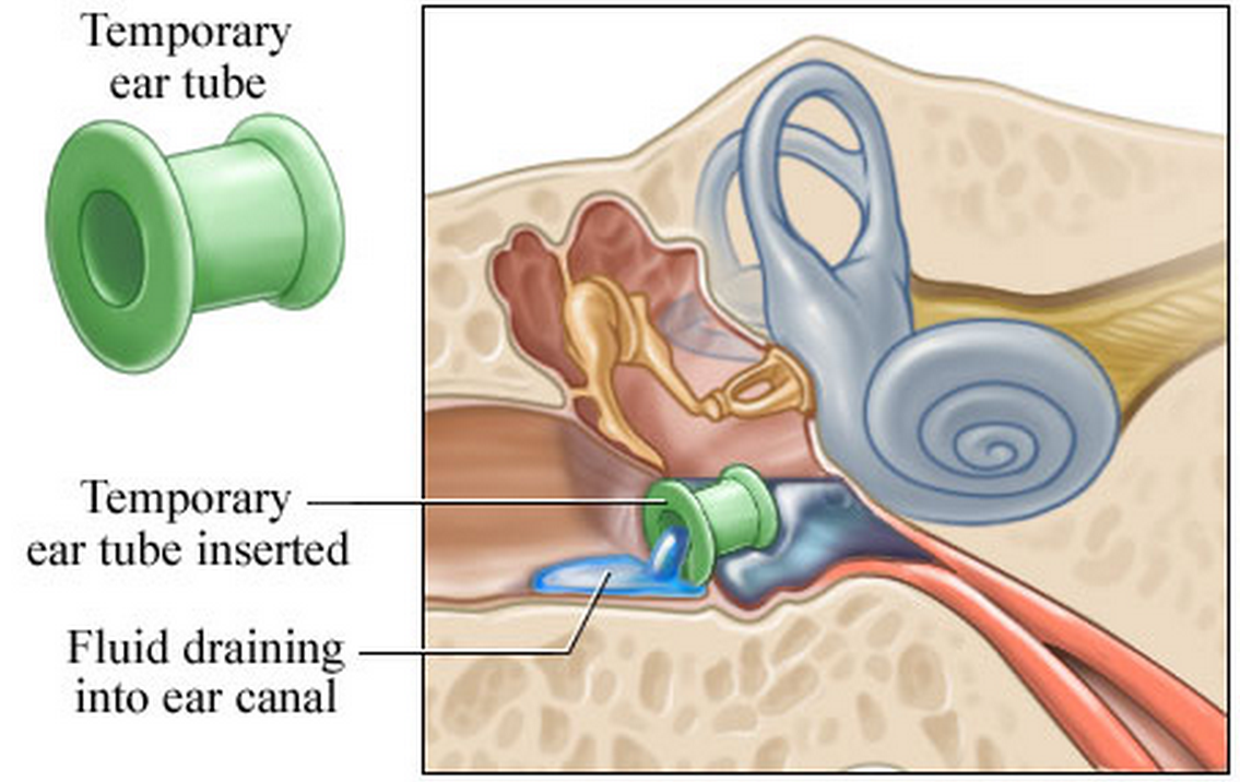 Myringotomy And Ear Tubes Fort Worth ENT Sinus