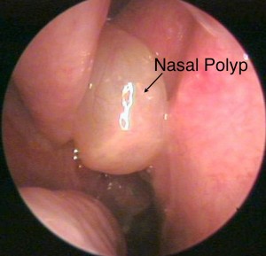 nasal polyps treatment with medications