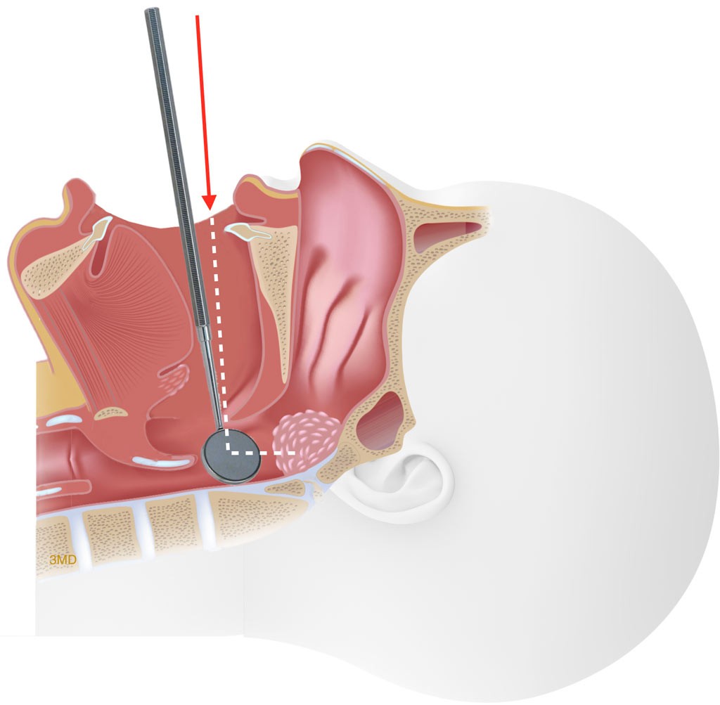 tonsillectomy procedure step by step