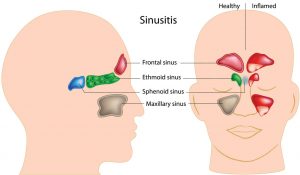 alloon Sinuplasty Sinusitis