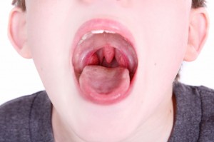 tonsils-in-a-child