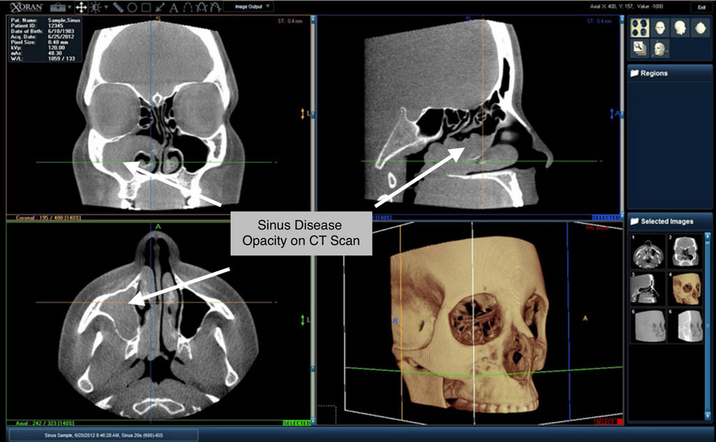 ct scan sinusitis