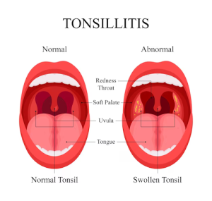 tonsil