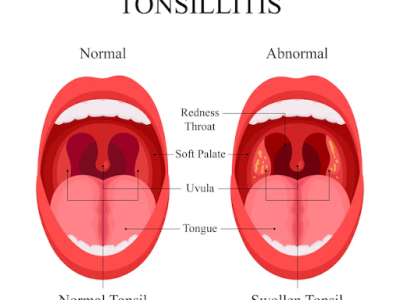 tonsil