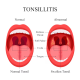 tonsil