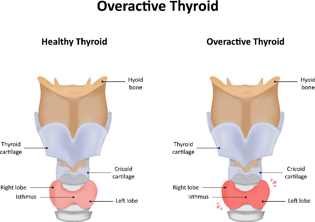 Thyroid Disease, Diagnosis and Treatment - Fort Worth ENT