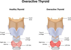 Hyperthyroidism, or overactive thyroid,