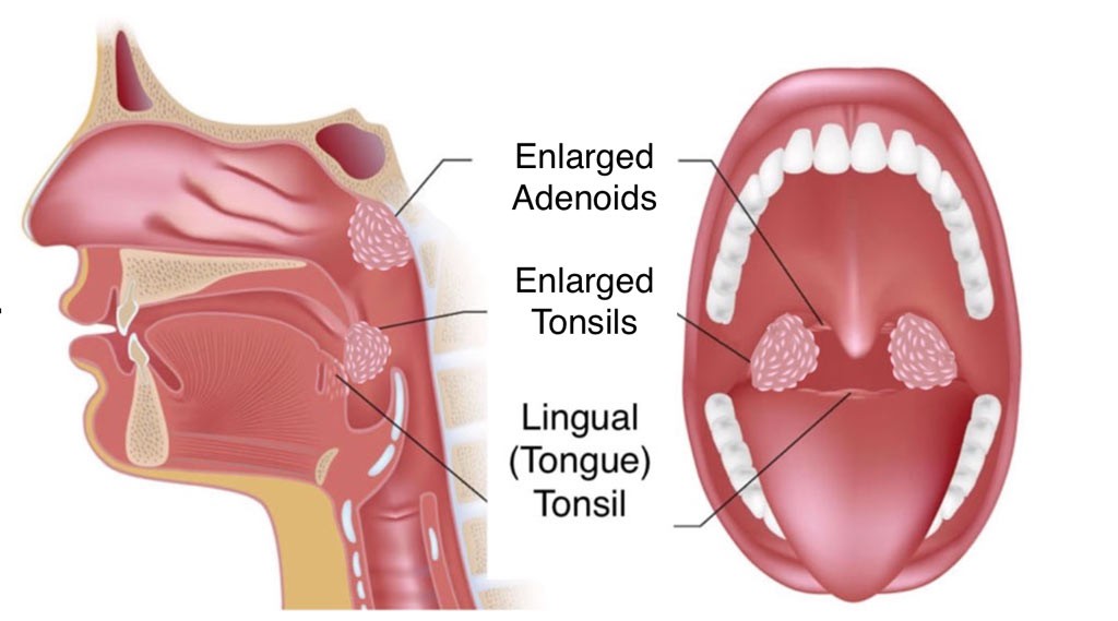 Surgery for Obstructive Sleep Apnea - Fort Worth ENT & Sinus