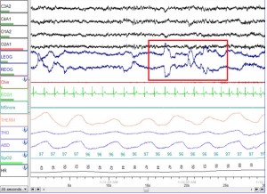 Nocturnal Polysomnography or PSG  Fort Worth ENT treats OSA