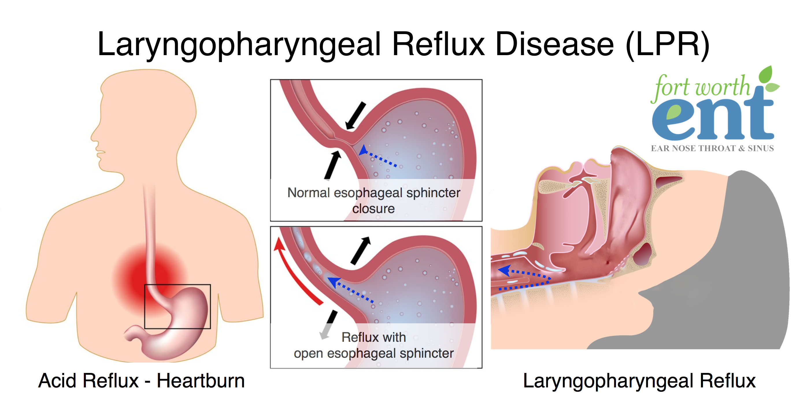 acid reflux throat