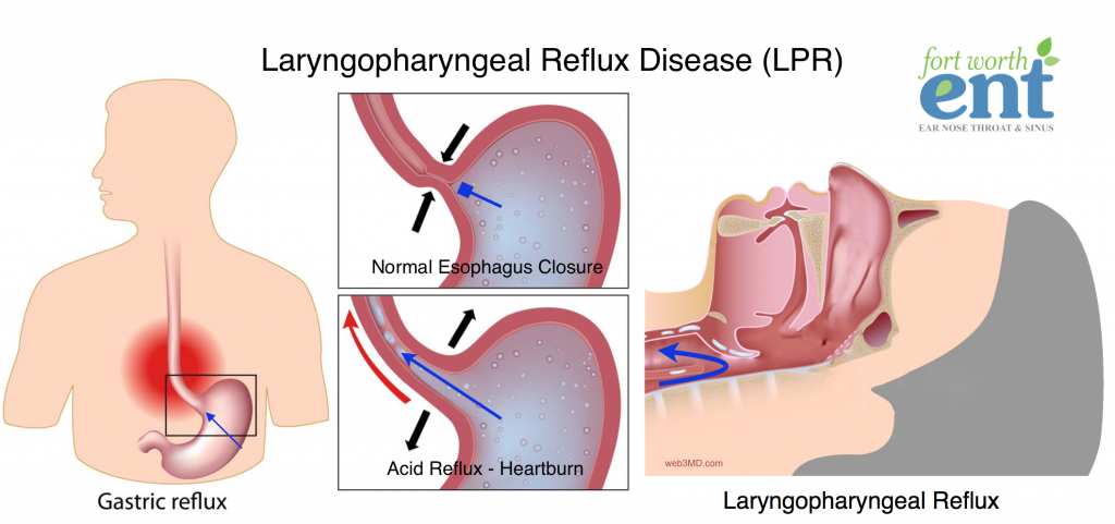 acid reflux throat