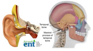 Tympanoplasty and mastoidectomy, tympanomastoidectomy