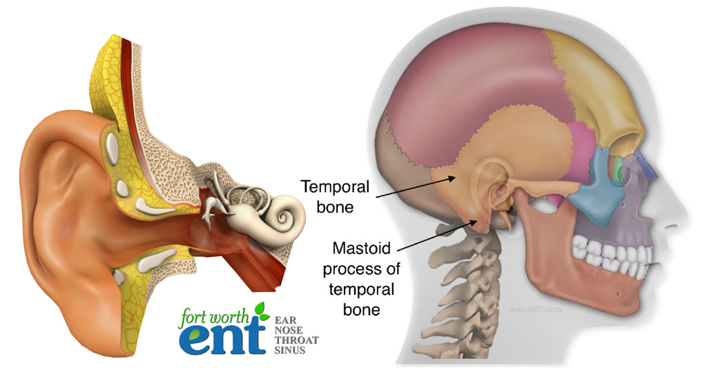 Fort Worth ENT Mastoidectomy and tympanoplasty (tympanomastoidectomy)