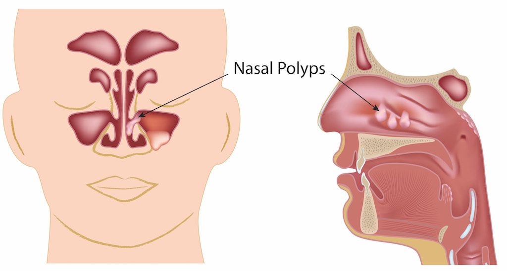 Nasal on sale congestion problems