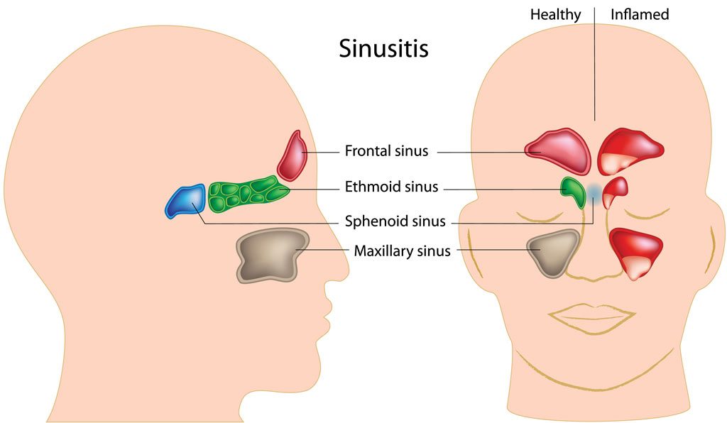 Sinusitis antibiotics deals