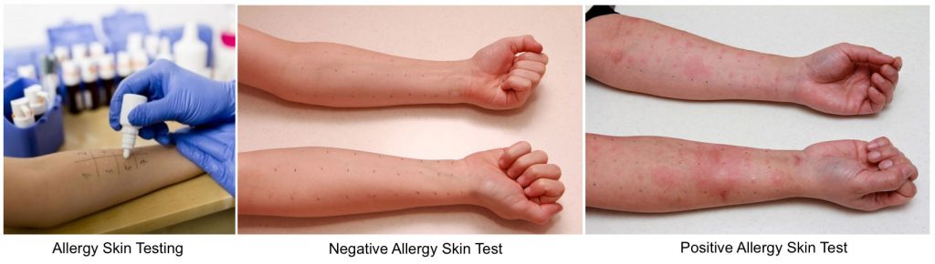 Types of Allergy Tests