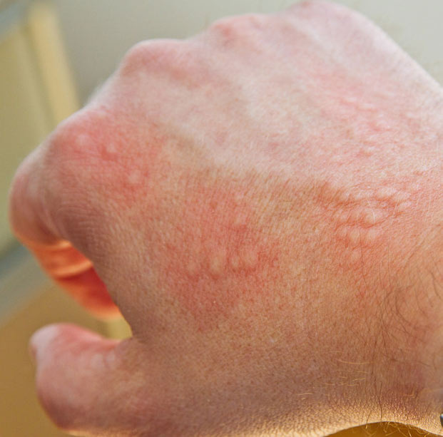 Skin Allergy Contact Dermatitis Fort Worth Ent And Sinus