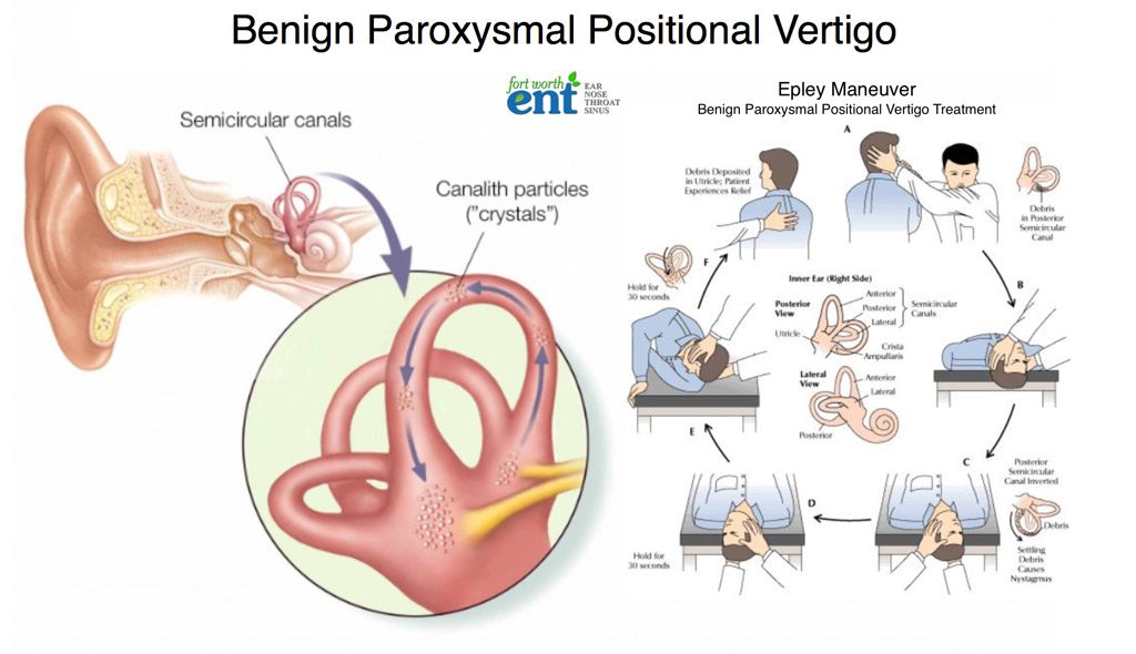 Dizziness Treatment Vertigo Epley Maneuver Fort Worth ENT