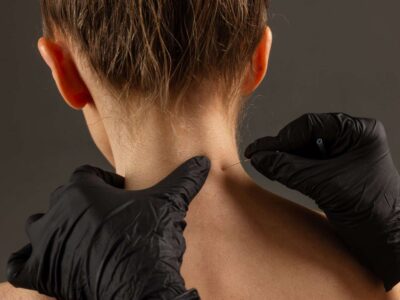 Radical Neck Dissection